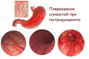 Гастрит, дуоденіт