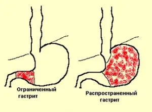 Гастрит - коли в животі все «горить»