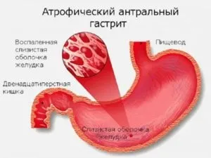 Гастрит, дуоденіт