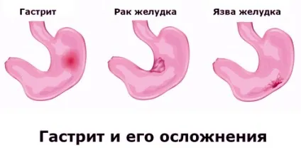 Гастрит лікування народними засобами моєї бабусі (гастрит) Гастрит лікування народними засобами моєї бабусі