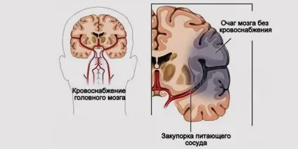 Ішемічний інсульт в вертебро-базилярному басейні ознаки і лікування (ішемічний) Ішемічний інсульт в вертебро-базилярному басейні ознаки і лікування