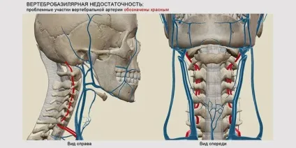 Ішемічний інсульт в вертебро-базилярному басейні ознаки і лікування (ознаки) Ішемічний інсульт в вертебро-базилярному басейні ознаки і лікування
