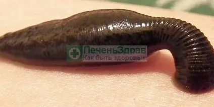 Як ставити п'явки на печінку правильно лікування (ставити) Як ставити п'явки на печінку правильно лікування