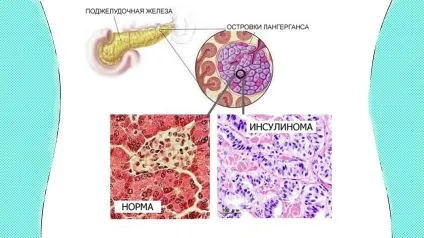 Як знизити інсулін в крові народними засобами (інсулін) Як знизити інсулін в крові народними засобами