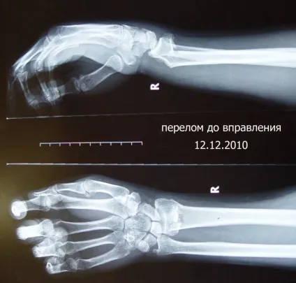 Як зняти набряк після перелому руки швидко і ефективно (набряк) Як зняти набряк після перелому руки швидко і ефективно