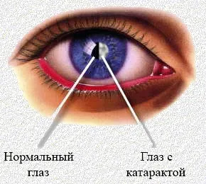 Катаракта після операції