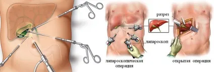 Калькульознийхолецистит що це таке симптоми і методика лікування (калькульозний холецистит) Калькульознийхолецистит що це таке симптоми і методика лікування