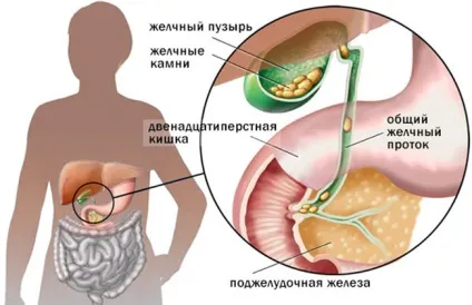 Калькульознийхолецистит що це таке симптоми і методика лікування (холецистит) Калькульознийхолецистит що це таке симптоми і методика лікування
