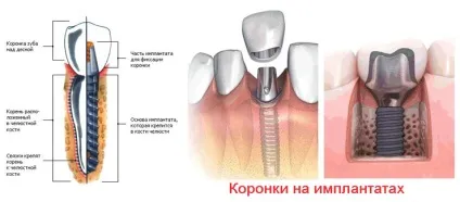 Коронка на імплант ціна, установка коронки на імплант (імплант) Коронка на імплант ціна, установка коронки на імплант
