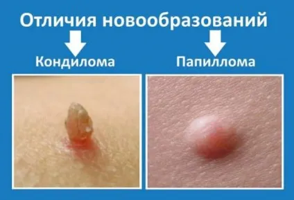 Кондиломи і папіломи чим вони відрізняються, методи лікування (папіломи) Кондиломи і папіломи чим вони відрізняються, методи лікування