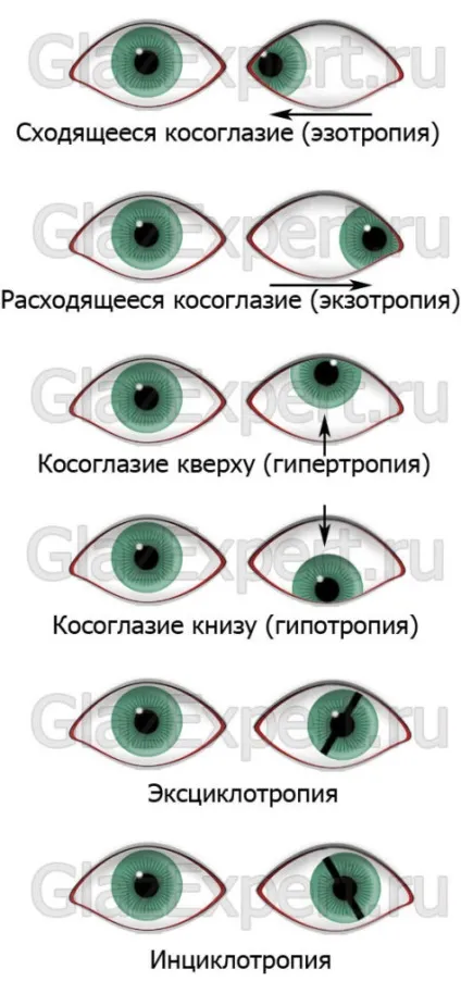 Косоокість (страбізм) причини, види, лікування та профілактика (види) Косоокість (страбізм) причини, види, лікування та профілактика