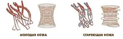 Лазерна гіалуронопластика (безголкового биоревитализация) (біоревіталізація) Лазерна гіалуронопластика (безголкового биоревитализация)