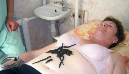 Лікування печінки п'явками як ставити і яка користь (п'явками) Лікування печінки п'явками як ставити і яка користь