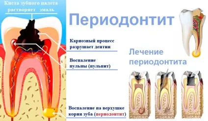 Лікування запалення ясен в домашніх умовах швидко і ефективно (лікування) Лікування запалення ясен в домашніх умовах швидко і ефективно