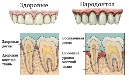 Лікування запалення ясен в домашніх умовах швидко і ефективно (запалення) Лікування запалення ясен в домашніх умовах швидко і ефективно