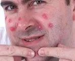 Багато дрібних прищів на лобі чому з'являються (з'являються) Багато дрібних прищів на лобі чому з'являються