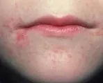 Багато дрібних прищів на лобі чому з'являються (з'являються) Багато дрібних прищів на лобі чому з'являються