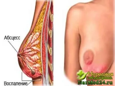 Містить профілактика і лікування методами народної медицини (мастит) Містить профілактика і лікування методами народної медицини