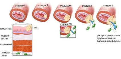 Новоутворення в стравоході злоякісні і доброякісні
