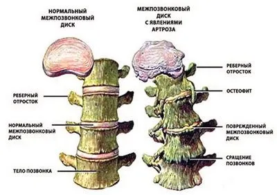 Остеофіти в грудному відділі хребта (остеофіти) Остеофіти в грудному відділі хребта