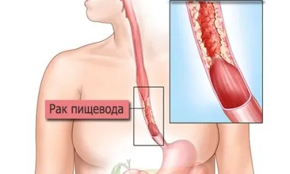 Пухлина стравоходу симптоми, ознаки, лікування (стравоходу) Пухлина стравоходу симптоми, ознаки, лікування