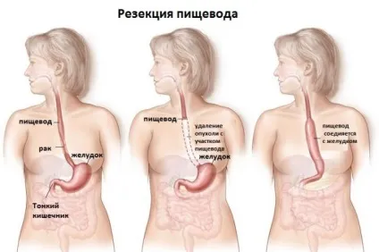 Пухлина стравоходу симптоми, ознаки, лікування (лікування) Пухлина стравоходу симптоми, ознаки, лікування