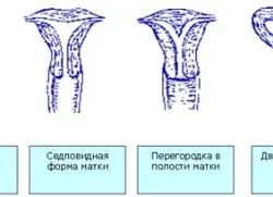 Перегородка в матці