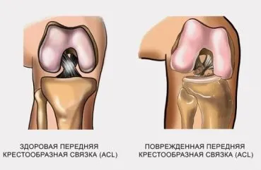 Пластика ПКС колінного суглоба подальше лікування і реабілітація (пластика) Пластика ПКС колінного суглоба подальше лікування і реабілітація