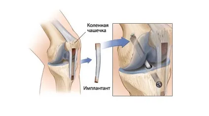 Пластика ПКС колінного суглоба подальше лікування і реабілітація (суглоба) Пластика ПКС колінного суглоба подальше лікування і реабілітація