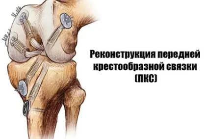 Пластика хрестоподібної зв'язки колінного суглоба (ПКС) (пластика) Пластика хрестоподібної зв'язки колінного суглоба (ПКС)
