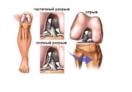 Пластика ПКС колінного суглоба подальше лікування і реабілітація (пластика) Пластика ПКС колінного суглоба подальше лікування і реабілітація