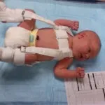 Ознаки та симптоми дисплазії у грудничка (дисплазії) Ознаки та симптоми дисплазії у грудничка