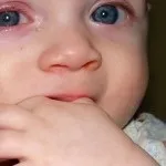 Ознаки та симптоми дисплазії у грудничка (дисплазії) Ознаки та симптоми дисплазії у грудничка