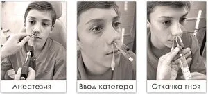 Процедура лікування гаймориту вакуумним методом з синус катетером ЯМІК, відгуки вдячних пацієнтів (ЯМІК процедура при гайморит синус катетер відгук) Процедура лікування гаймориту вакуумним методом з синус катетером ЯМІК, відгуки вдячних пацієнтів