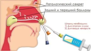 Процедура лікування гаймориту вакуумним методом з синус катетером ЯМІК, відгуки вдячних пацієнтів (гаймориту) Процедура лікування гаймориту вакуумним методом з синус катетером ЯМІК, відгуки вдячних пацієнтів