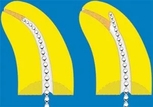 Пульпектоміі (девітальная і вітальна екстирпація пульпи) показання і техніка ампутації (екстирпація) Пульпектоміі (девітальная і вітальна екстирпація пульпи) показання і техніка ампутації
