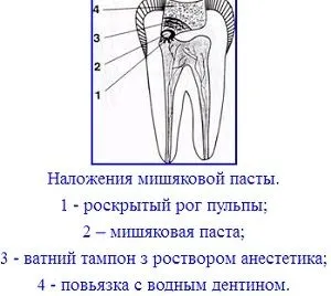 Пульпектоміі (девітальная і вітальна екстирпація пульпи) показання і техніка ампутації (вітальна екстирпація пульпи) Пульпектоміі (девітальная і вітальна екстирпація пульпи) показання і техніка ампутації