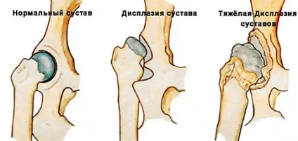 Ознаки та симптоми дисплазії у грудничка (грудничка) Ознаки та симптоми дисплазії у грудничка