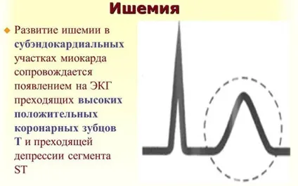Ознаки ішемічної хвороби серця, ЕКГ при ІХС