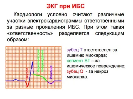 Ознаки ішемічної хвороби серця, ЕКГ при ІХС