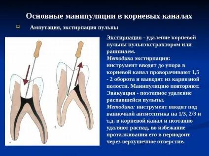 Пульпектоміі (девітальная і вітальна екстирпація пульпи) показання і техніка ампутації (девітальная ампутація) Пульпектоміі (девітальная і вітальна екстирпація пульпи) показання і техніка ампутації