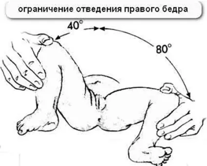 Ознаки та симптоми дисплазії у грудничка (ознаки) Ознаки та симптоми дисплазії у грудничка