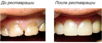 Реставрація зубів методи, результат (реставрація) Реставрація зубів методи, результат