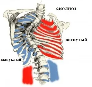 Симптоми і ознаки сколіозу чим викликана хвороба, причини виникнення викривлення хребта (хвороба) Симптоми і ознаки сколіозу чим викликана хвороба, причини виникнення викривлення хребта