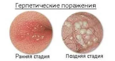 Висип у паху у жінки фото з поясненнями симптоми захворювання (жінки) Висип у паху у жінки фото з поясненнями симптоми захворювання