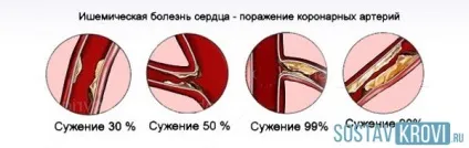 Шунтування серця що це таке, як проводиться, ускладнення і відновлення після операції (серця) Шунтування серця що це таке, як проводиться, ускладнення і відновлення після операції