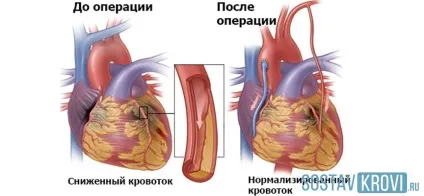 Шунтування серця що це таке, як проводиться, ускладнення і відновлення після операції (таке) Шунтування серця що це таке, як проводиться, ускладнення і відновлення після операції
