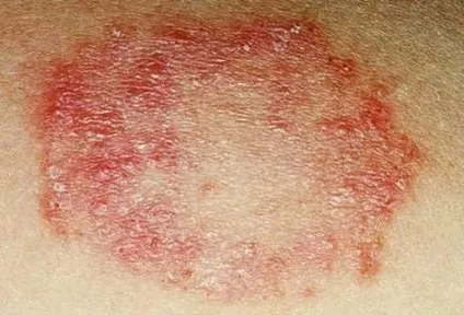 Висип у паху у жінки фото з поясненнями симптоми захворювання (паху) Висип у паху у жінки фото з поясненнями симптоми захворювання