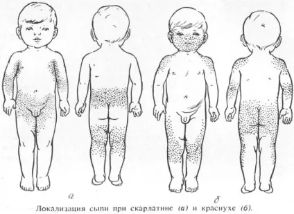 Скарлатина у дітей фото, симптоми, лікування і профілактика (лікування) Скарлатина у дітей фото, симптоми, лікування і профілактика