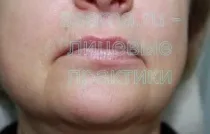 Спазми і гіпертонус м'язів обличчя - зможу сама (напруженими) Спазми і гіпертонус м'язів обличчя - зможу сама